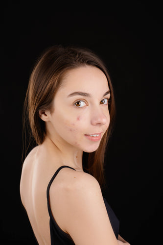 A woman dressed in a sophisticated black ensemble, with visible acne on her face, highlighting real skin challenges and the importance of effective skincare.